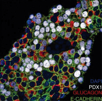 Image: Treatment of human islets with the histone methyltransferase inhibitor Adox results in co-localization of the beta-cell specific transcription factor PDX1 (white) in a substantial subpopulation of glucagon-positive cells (red), indicating partial endocrine cell-fate conversion (Photo courtesy of  Nuria Bramswig, Perelman School of Medicine, University of Pennsylvania).	